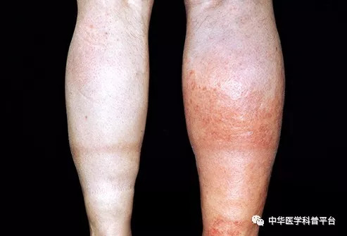 你需要知道的睡眠知识,医生告诉你血栓那些事