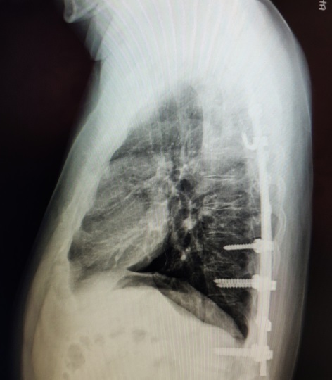 脊柱侧弯手术后肋骨外翻,脊柱侧弯做手术后续