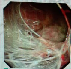 胸水为什么会抽不到,胸水抽了为什么还呼吸困难