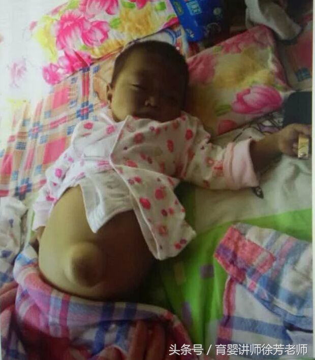 宝宝肚脐眼有点鼓是什么原因,小婴儿肚脐眼鼓起来了怎么办