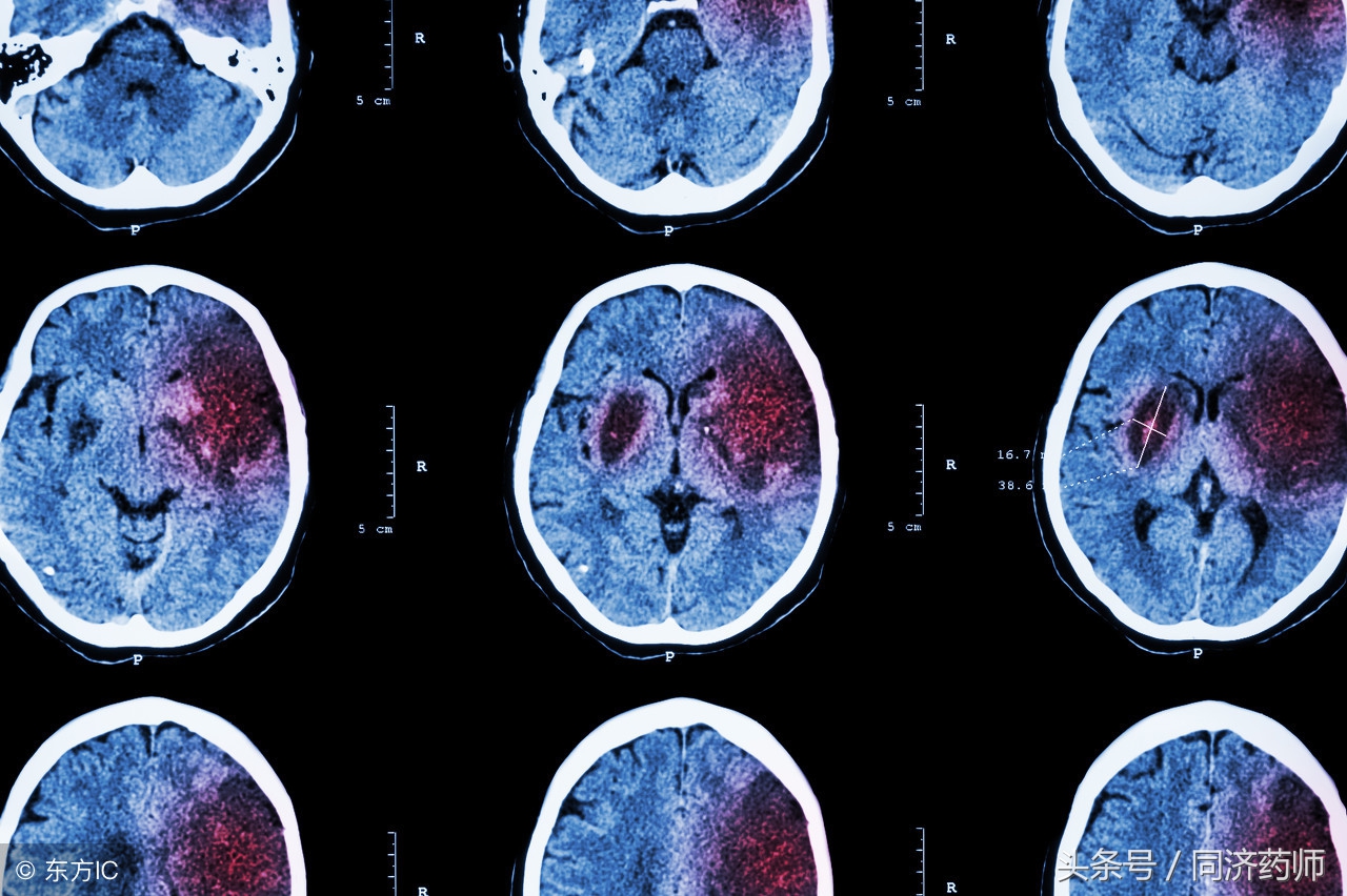 脑中风是老年痴呆吗,脑中风是老年病吗