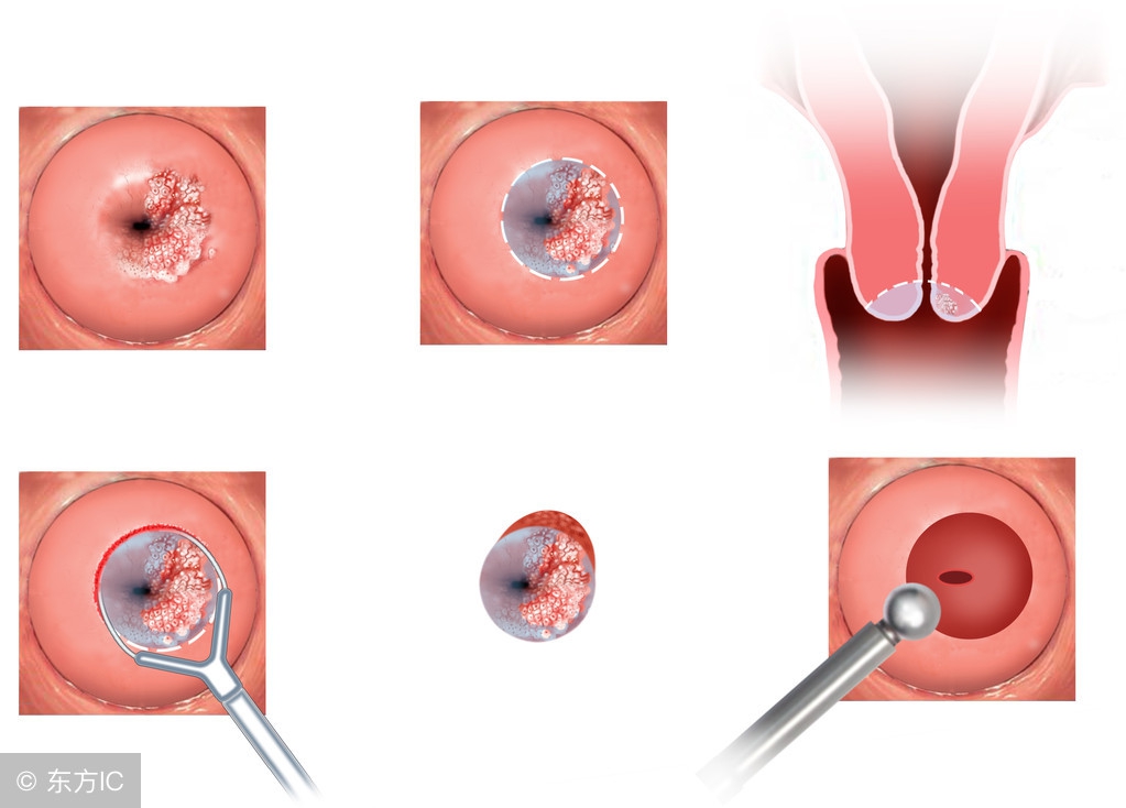 宫颈糜烂过度医疗,宫颈糜烂容易引发的疾病