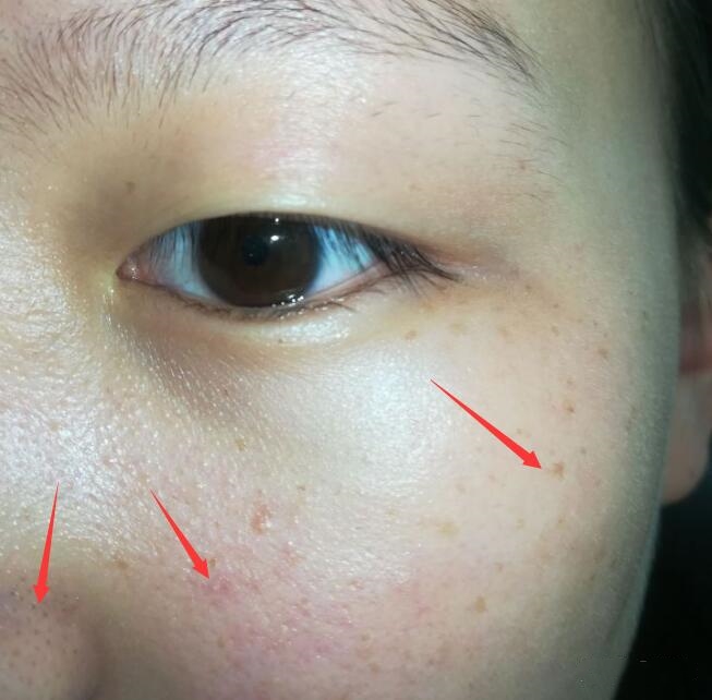 寄生在人脸上的螨虫有多可怕,脸上有螨虫要忌口