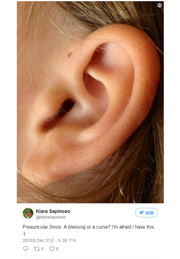 耳朵上方有小洞,耳朵上方有一个小洞代表什么