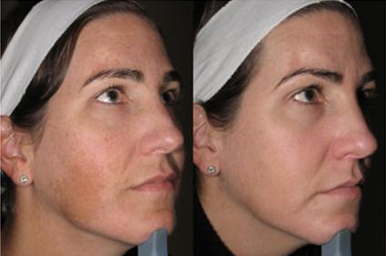 我脸上有很多色斑打激光能治好吗,我脸上的斑能去吗