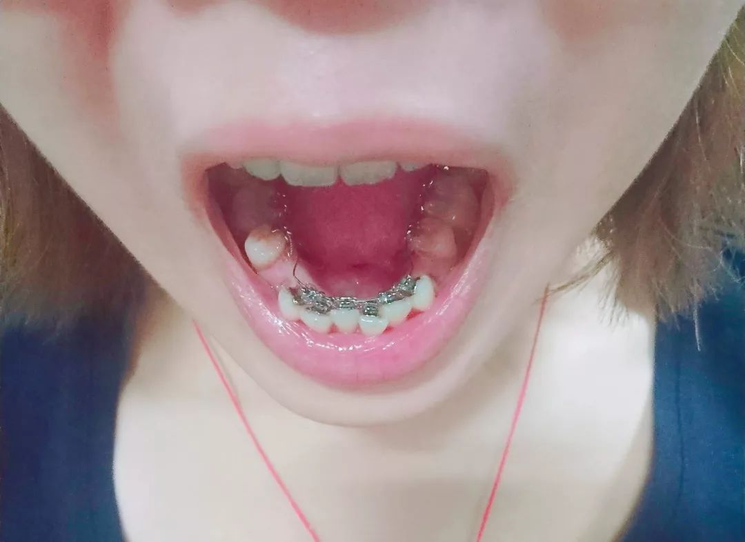 整牙就整两个门牙可以吗,整牙只是为了好看么