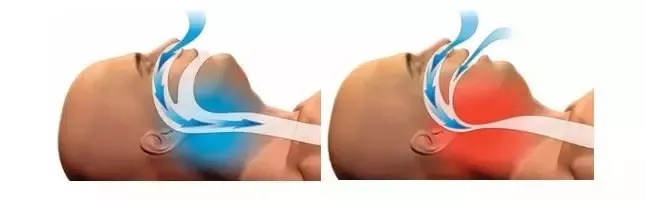 科普知识打鼾对心血管健康的危害,科普健康打呼噜