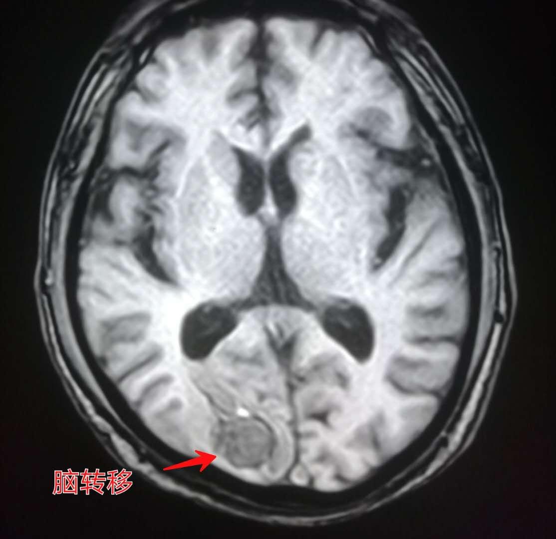 4种症状要查脑血管,这些症状一定要做脑血管造影