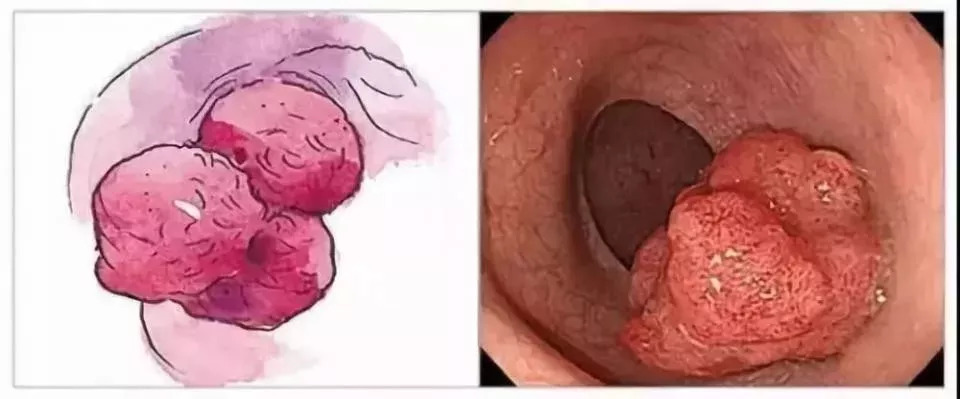 肠息肉是怎么引起的怎么治疗,肠息肉有什么办法阻止其生长