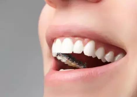 整牙后颜值明显变化的明星,明星真的会因为整牙而变漂亮了吗