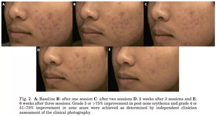 痘印特效药,斑点痘印的克星