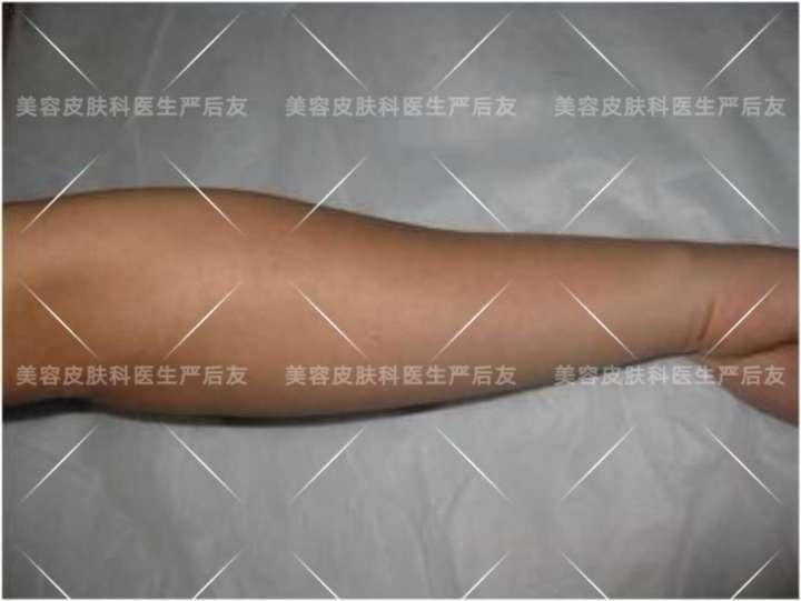 上海面部激光脱毛,日本全身激光脱毛