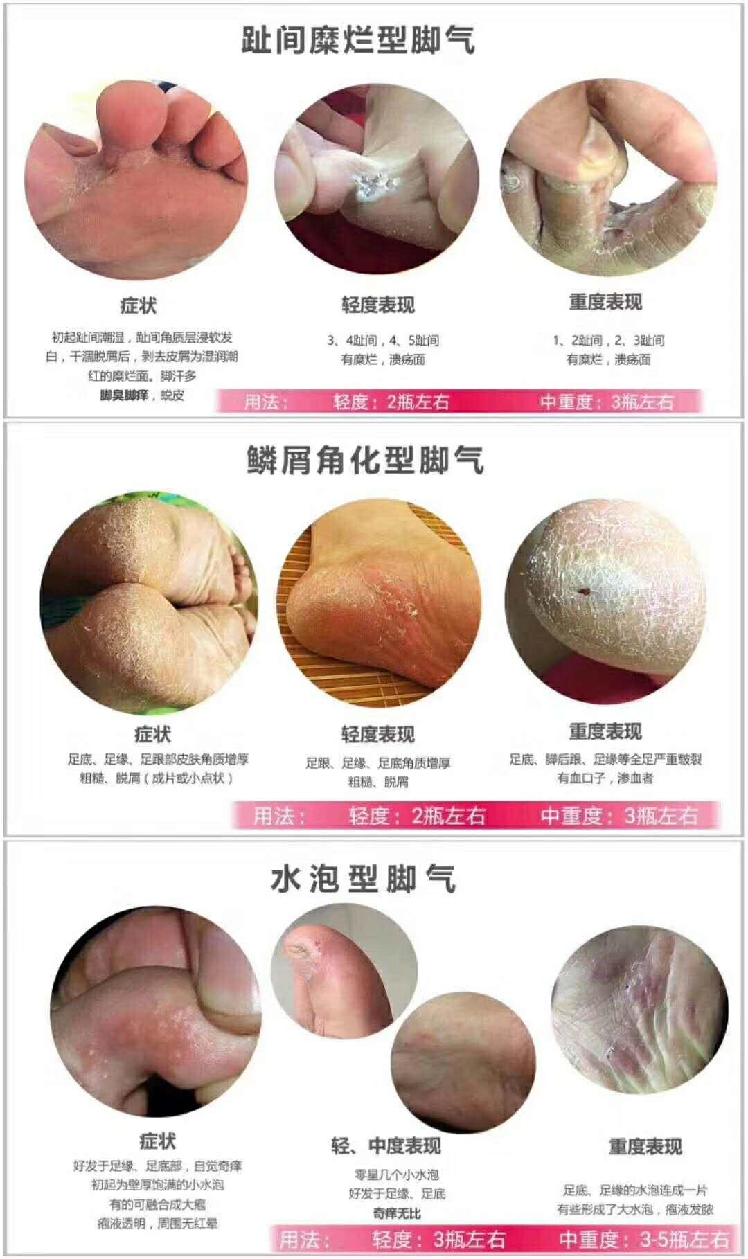 脚气用什么药膏涂抹好得快,脚气用什么药膏治疗是最有效的