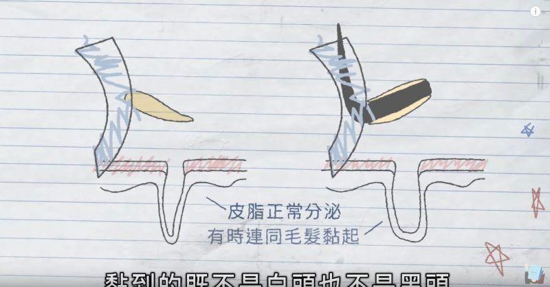 黑头贴吸出来的是粉刺还是黑头,去黑头闭口粉刺用黑头贴可以吗