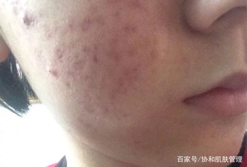 脸上的痘坑痘印怎么消除,脸上很多坑如何修复