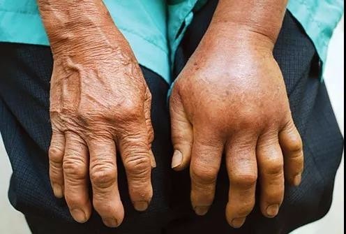 毒蛇咬伤需不需要截肢,被毒蛇咬后截肢会得昂髓炎吗