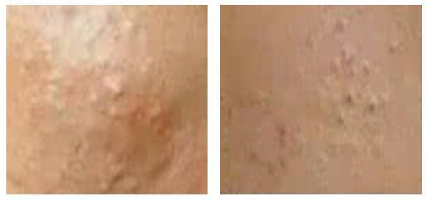 闭口痘痘涂什么药膏医生推荐,闭口粉刺痘痘痘印用什么护肤品