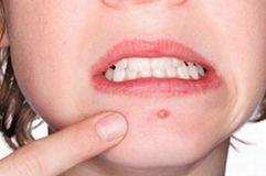 闭口痘痘推荐药膏,治疗粉刺闭口痘印药膏