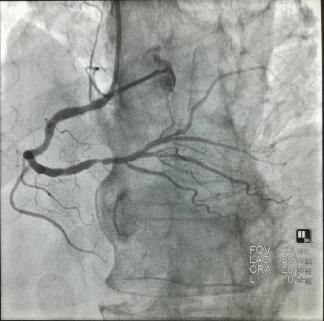 心脏溶栓和支架的区别是什么,心脏溶栓和支架的区别