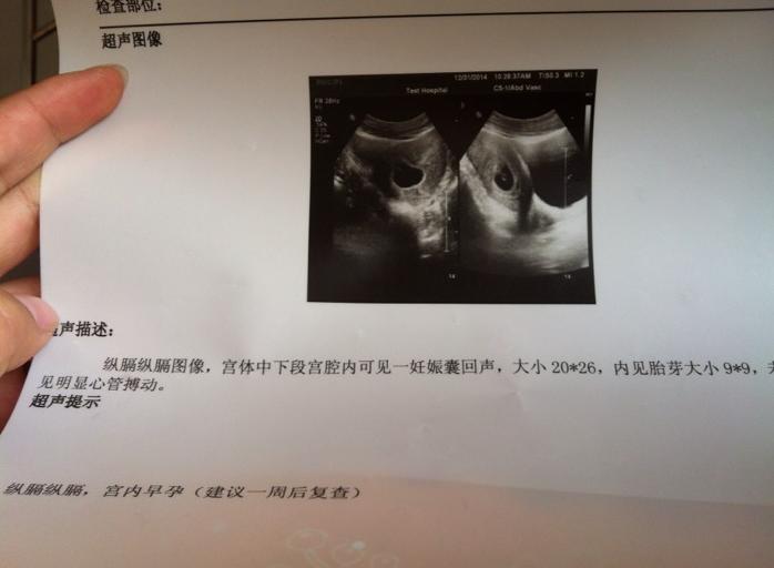 先兆流产没有胎心胎芽能保住吗,产检检查不出来胎儿哪些问题