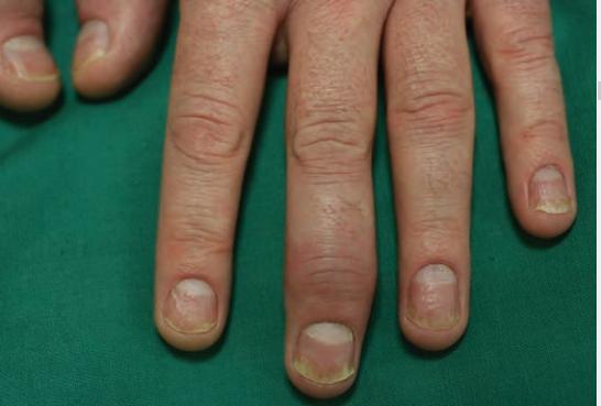 银屑病关节炎和银屑病区别,银屑病关节炎跟银屑病一样吗