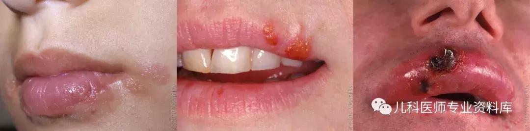 宝宝嘴巴上火的症状,宝宝嘴巴臭是积食还是上火