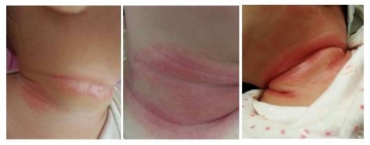 婴儿肌肤总有问题,远离宝宝肌肤问题