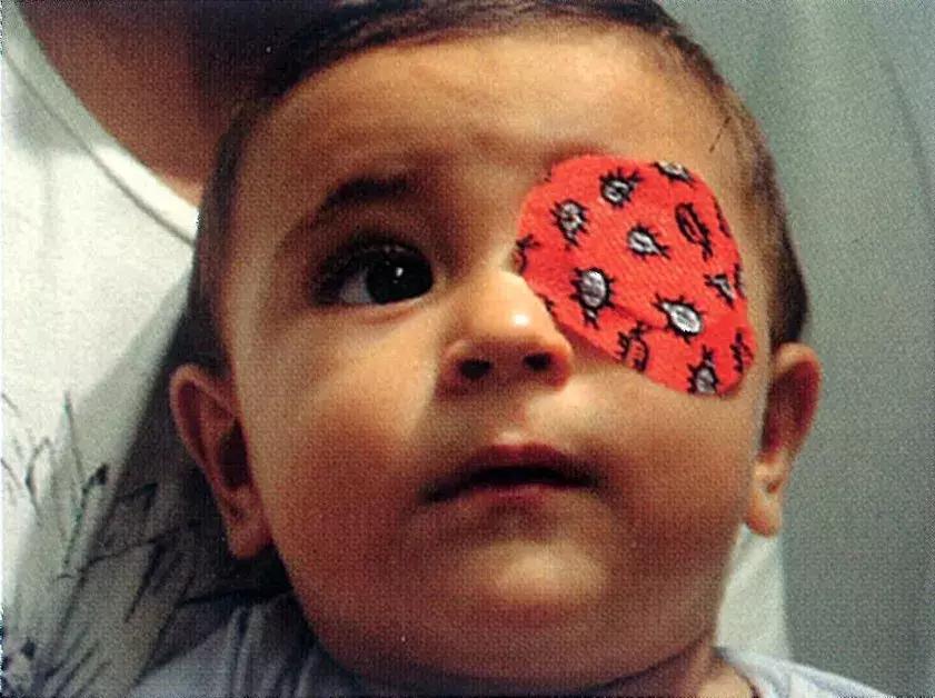 传统过时的弱视治疗方法（上）