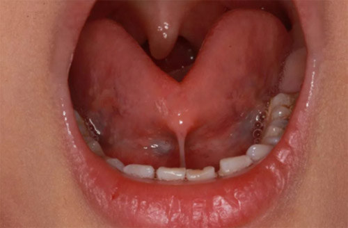 孩子舌筋过短怎么办,舌筋过短