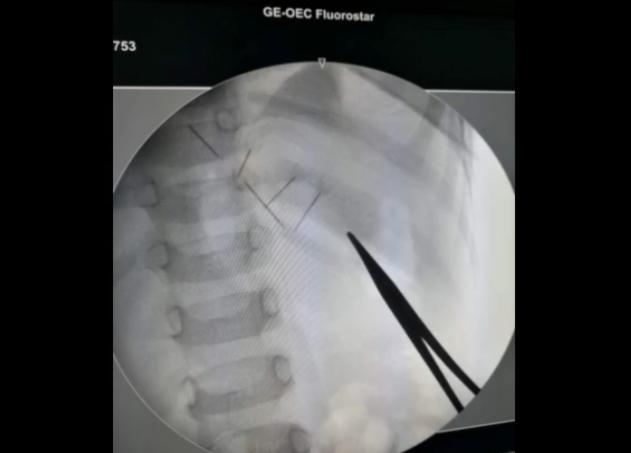 两岁半宝宝体内藏针,两岁儿童缝衣针