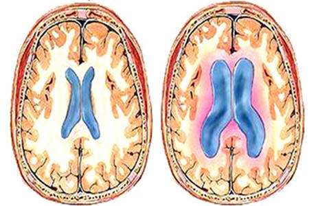 中医脑积水怎么治疗,脑积水的治疗方法