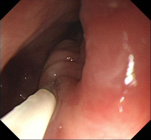 肝硬化中西医结合治疗并发症,肝硬化tips介入手术并发症