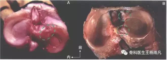关于半月板的正确说法,半月板前世是什么