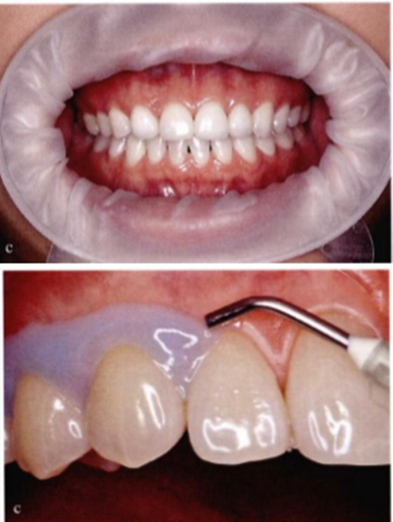 美白牙齿不伤牙齿的方法,牙齿黄不好看怎么美容