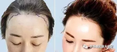 毛发移植术技术成熟吗,微毛发移植术