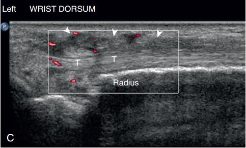 世界银屑病日银屑病关节炎,银屑病关节炎是银屑病后期吗
