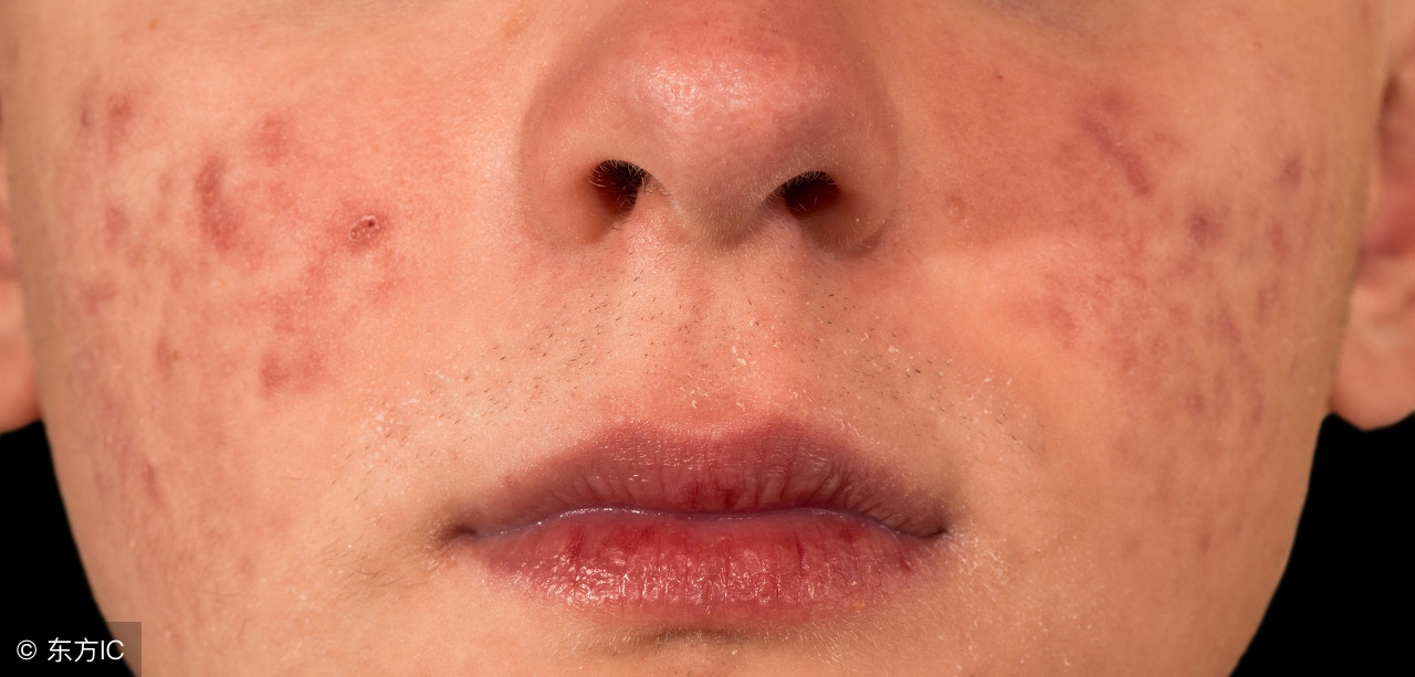 床垫有螨虫小孩睡了过敏,螨虫过敏者铺什么床垫最好