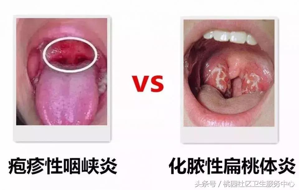 家长们注意了!孩子得了化脓性扁桃体炎怎么办?