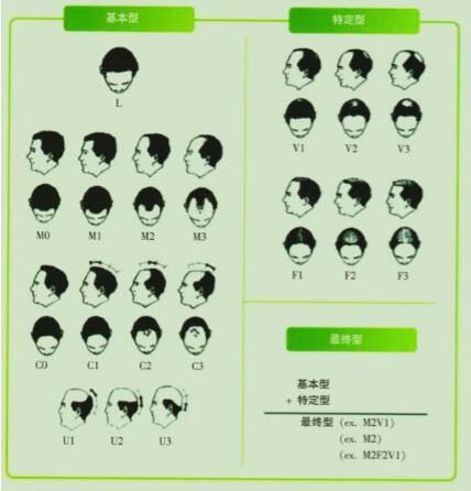 5个原因导致男人脱发,雄激素性脱发能治吗