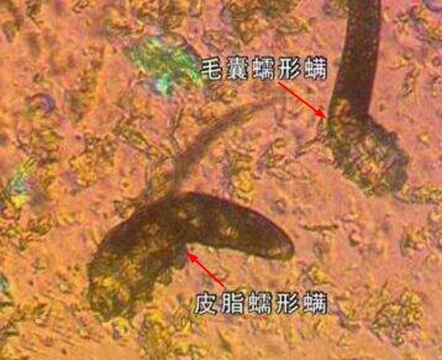 秋天螨虫怎么消除,脸上有螨虫小编教你一招解决螨虫