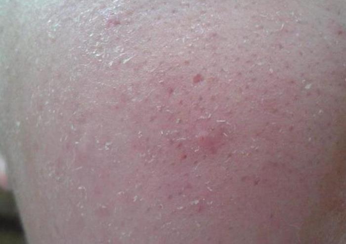 床上螨虫多皮肤会有很多痘痘吗,床上的螨虫到底有多少