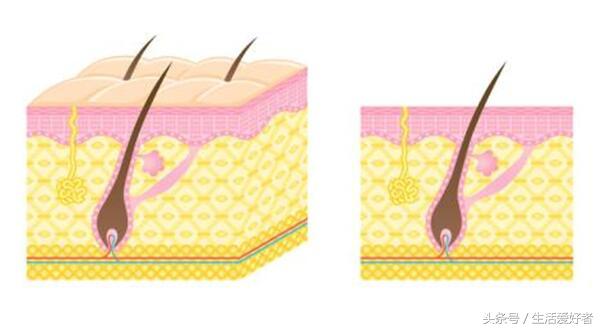 毛孔疏通后还能长头发吗,毛孔未闭合怎么长头发