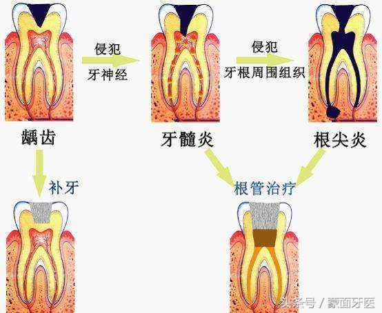 关爱牙齿预防虫牙从小做起,儿童漱口水可以预防虫牙