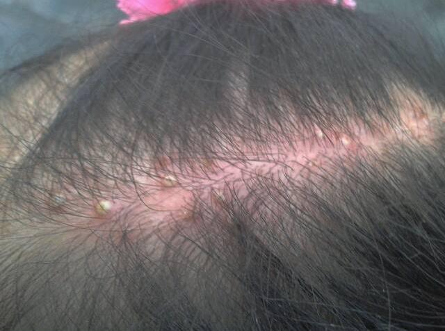 怎么除头螨虫最有效方法,头上螨虫怎么去除简单方法