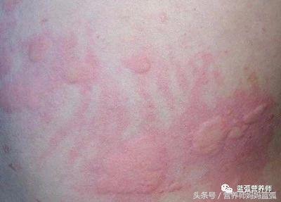 每5个人就有1个患寻麻疹，这样调理才能治本！