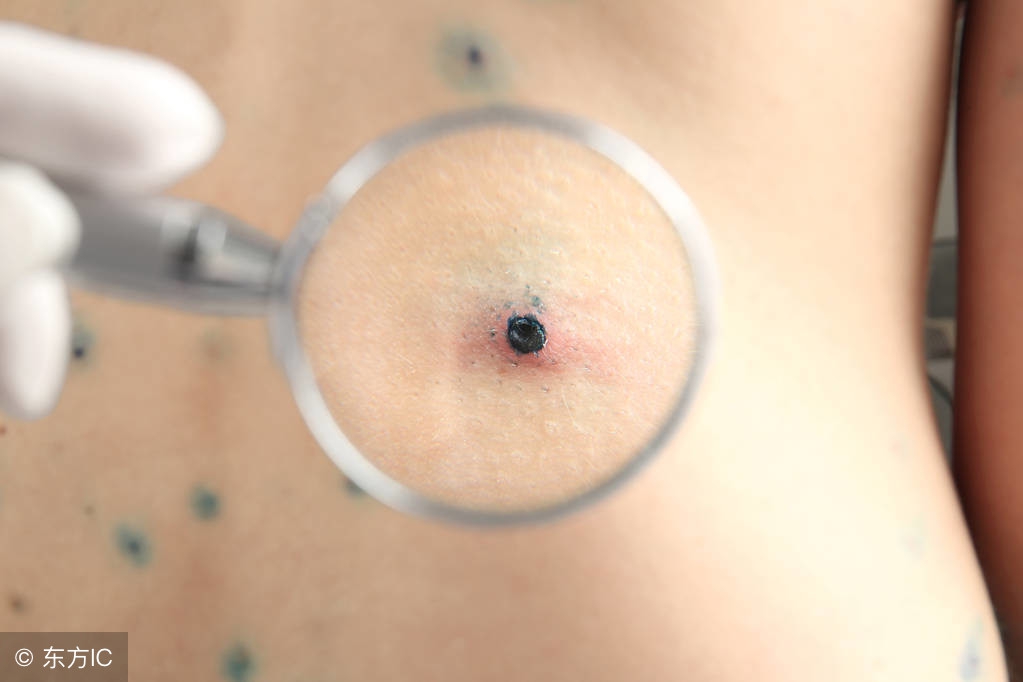 从小就有的痣可能会是黑色素瘤吗,先天性黑素细胞痣恶变的概率大吗