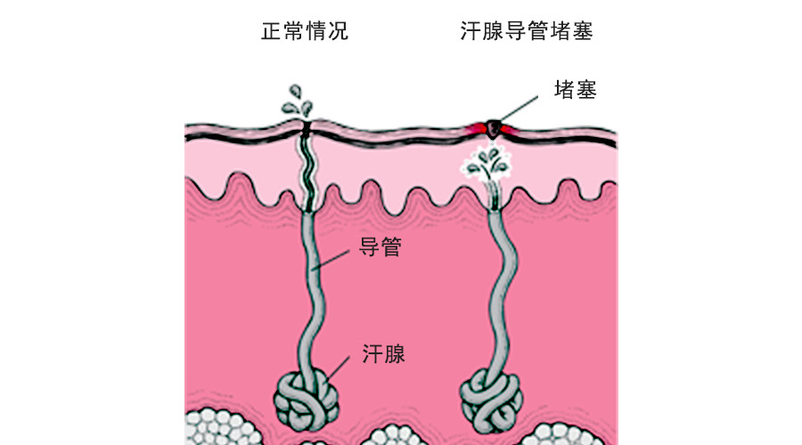 怎么分清痱子还是湿疹,怎么分清是痱子还是湿疹