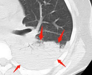 患结核的帅小哥很憋屈:4个月没牵女朋友的手,我现在还传染吗?