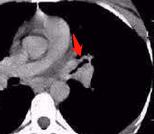 患结核的帅小哥很憋屈:4个月没牵女朋友的手,我现在还传染吗?