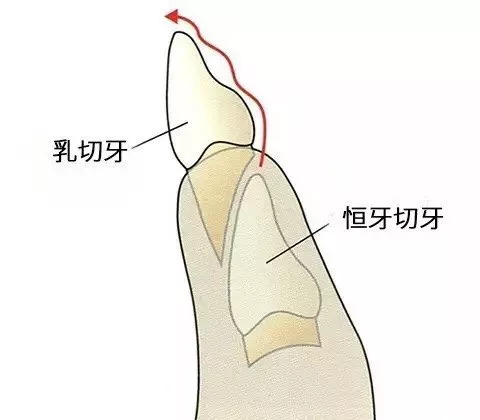 孩子要换牙这6点必须注意,过早换牙的孩子要注意
